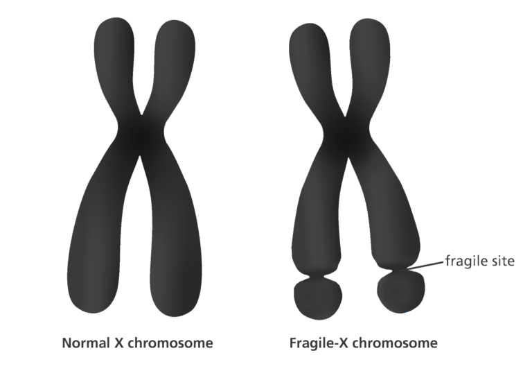 EHL Fragile X – Fragile X Syndrome Is A Genetic Condition That Causes A ...